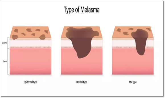 What You Must Know Before Getting Myeongdong Picotoning Treatment image 6