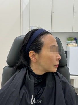 목동역실리프팅 윤곽정리가 필요하다면 관련 이미지 6