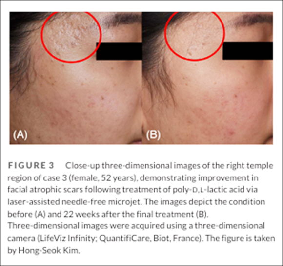 Understanding the Principles of Scar Treatment Through Research on Mokdong Juvelook image 4