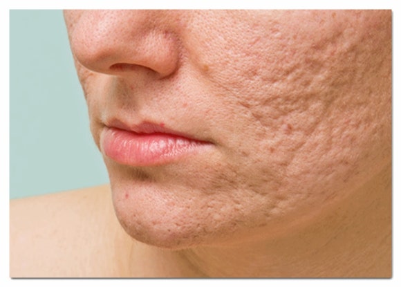 Mokdong Fraxel: Reviewing the Effects on Enlarged Pores and Acne Scars Through Research Papers image 4