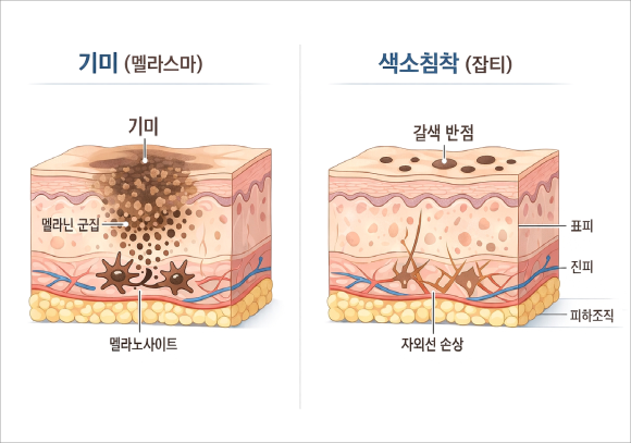 Key Points for Reducing Recurrence After Mung-dong Melasma Removal image 2