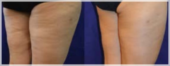 I Lost Weight, So Why Is the Cellulite Still There? <Why InMode BodyFX Is Needed> image 6
