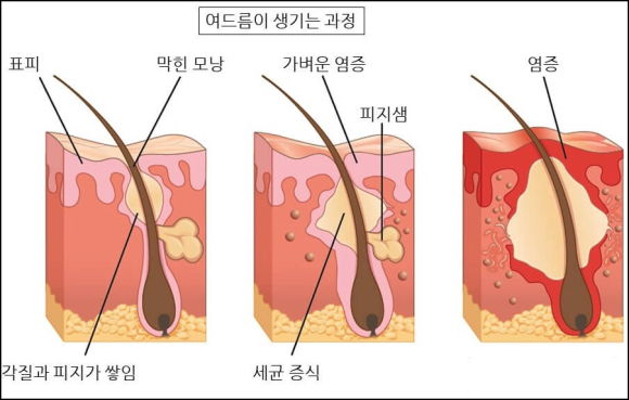 오목교역피부과, 여드름 피부 방치해도 나아질까? 관련 이미지 2