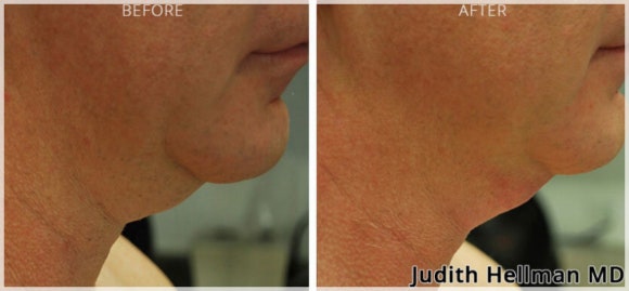 I Lost Weight, So Why Is the Cellulite Still There? <Why InMode BodyFX Is Needed> image 8