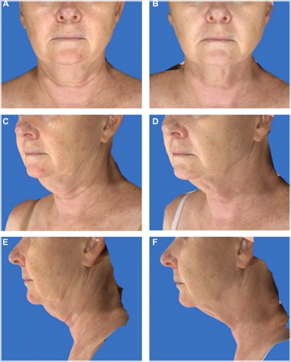 Why Mok-dong Ulthera Is the Standard for Skin Tightening Procedures image 6