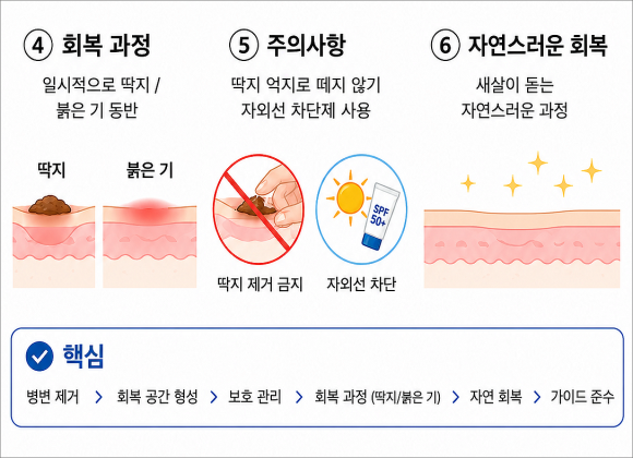 목동비립종 사후 관리 가이드까지 꼼꼼히 확인하세요 관련 이미지 5