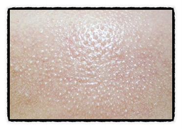 It Is Important to Properly Manage Acne in Mok-dong from the Early Stages <Written by a Doctor> image 2