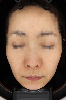 목동 레이저토닝 기미 주근깨 치료 제대로 하려면 관련 이미지 8