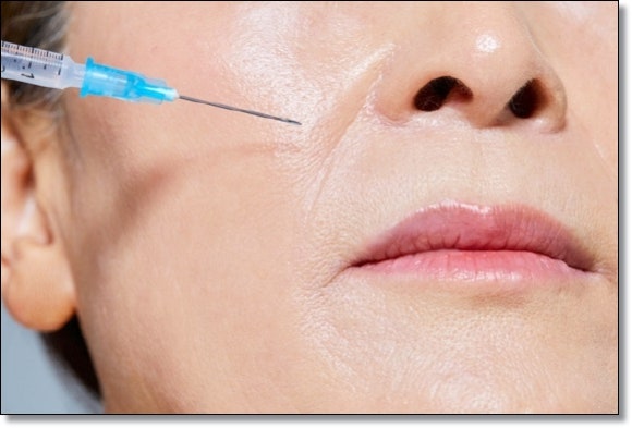 Omokgyo Filler: If wrinkles make you feel self-conscious when smiling image 6