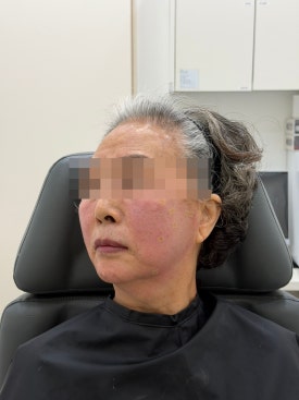 When Fillers Alone Aren’t Enough: Mokdong Thread Lifting image 12