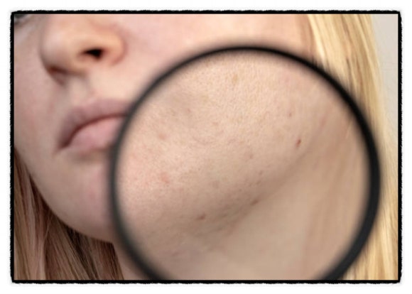 Aqua Peel Pore Care Can Be the Start of Skin Refinement image 2