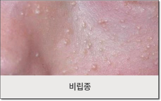 목동비립종, 얼굴에 올라온 하얀 점들 깨끗이 제거하려면? 관련 이미지 2