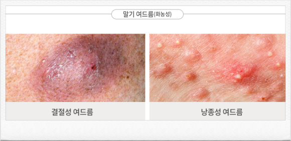 양천구여드름 흉터 남기 전에 신속하게 대응해야 하는 이유 <의사 작성> 관련 이미지 5