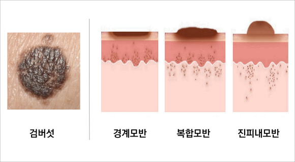 목동점제거, 이것만큼은 꼭 확인하세요. 관련 이미지 2