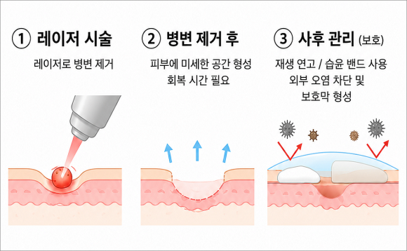 목동비립종 사후 관리 가이드까지 꼼꼼히 확인하세요 관련 이미지 4