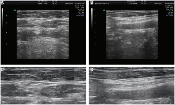 Looking Into Mokdong InMode Lifting Results? We’ll Explain With Objective Journal Data image 5