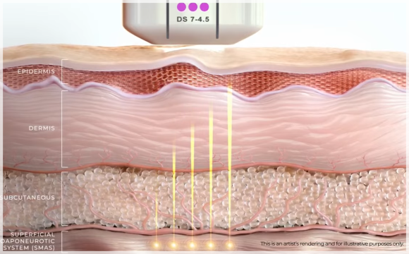 Comparing Moksdong Ulthera, Shurink, and Thermage image 2