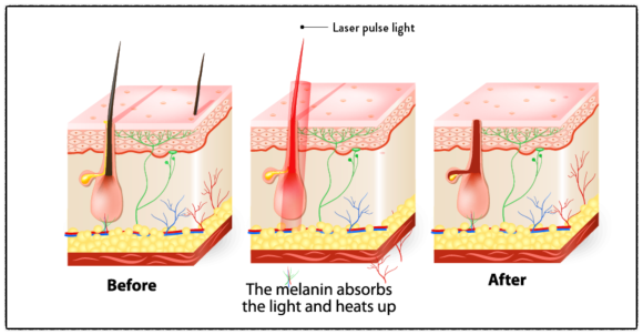 What Determines the Number of Mokdong Laser Hair Removal Sessions? <Written by a Doctor> image 3