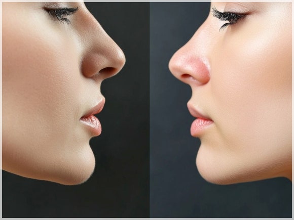 Filler Effects by Area? This Was the Best Spot [Paper Attached] image 8