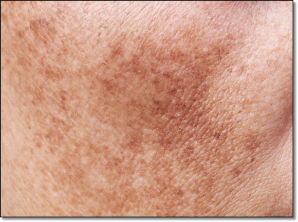 Mokdong Pico Toning: How Is It Different from Regular Laser Toning? image 2