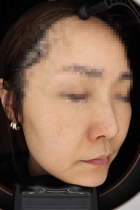 목동 레이저토닝 기미 주근깨 치료 제대로 하려면 관련 이미지 10