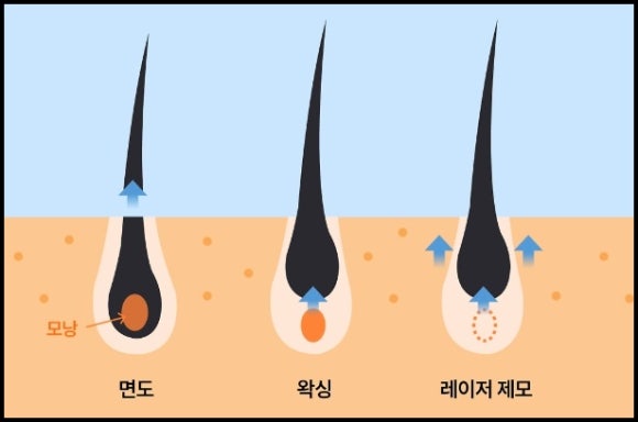 목동레이저제모, 반영구적인 제모가 필요하다면? 관련 이미지 2