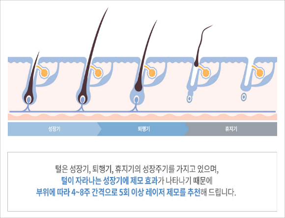 오목교레이저제모, 결정 전 꼭 알아야 할 관련 이미지 4