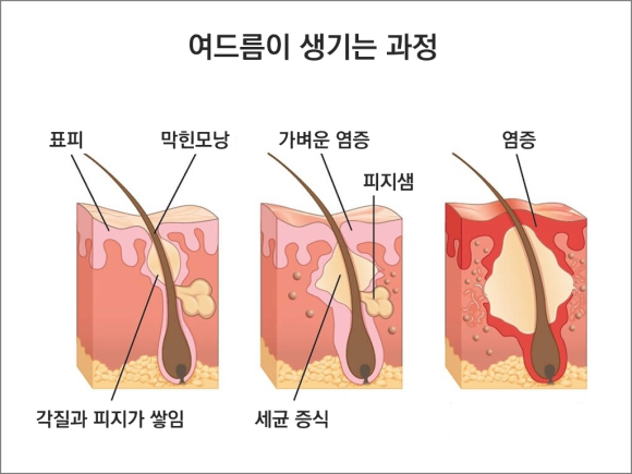 Key Points You Must Keep in Mind During Acne Treatment in Yangcheon-gu image 2