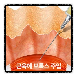 양천구보톡스 눈에 띄는 변화는 언제부터 생기는 걸까? 관련 이미지 4