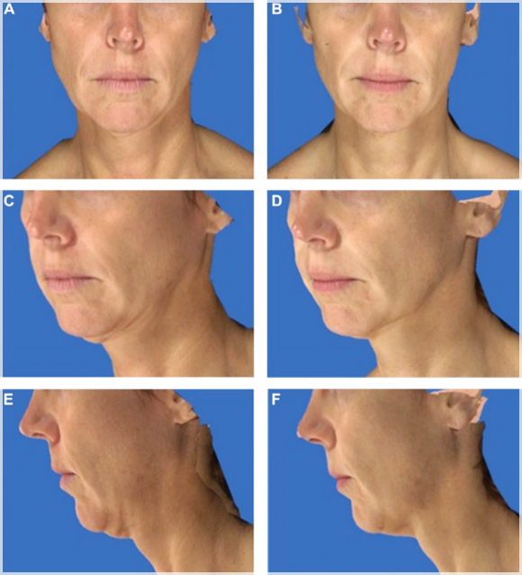 Why Mok-dong Ulthera Is the Standard for Skin Tightening Procedures image 5