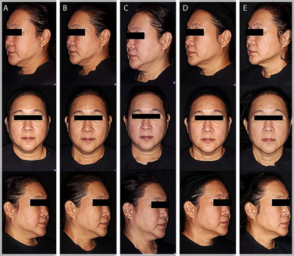 Can You Have Lifting If Your Skin Is Thin and You Don’t Have Much Cheek Fat? – A Guide to Oligio for You [Paper Attached] image 4