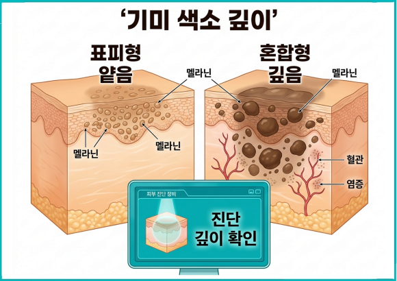 Mokdong Melasma Removal: Why Doesn’t Melasma Disappear Easily? Understanding the Causes First image 2