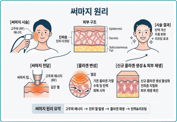 오목교피부과 써마지FLX, 효과는 언제부터? 유지 기간과 샷 수까지 관련 이미지 2