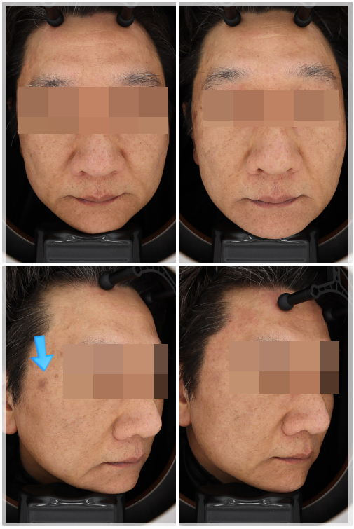목동 레이저토닝, 기미와 잡티가 반복된다면 관련 이미지 5
