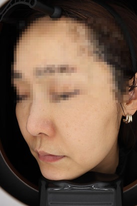 목동 레이저토닝 기미 주근깨 치료 제대로 하려면 관련 이미지 12