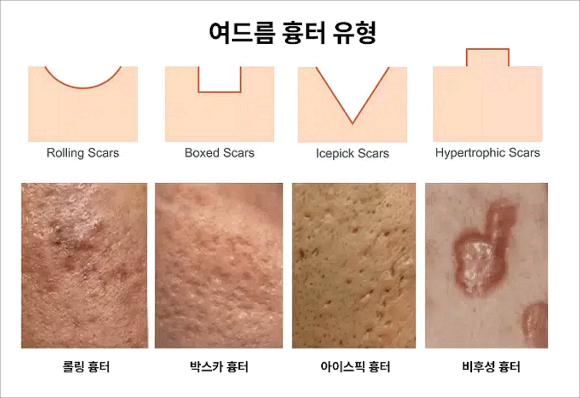 Mokdong Station Acne Treatment: Why Everything from Sebaceous Gland Control to Extraction Care Matters image 5