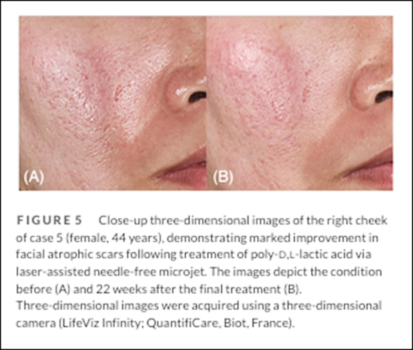 Understanding the Principles of Scar Treatment Through Research on Mokdong Juvelook image 5