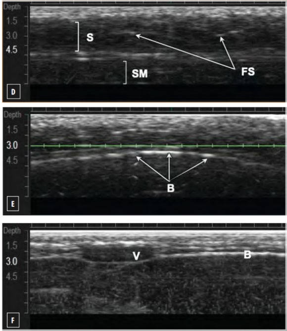 Why Is Ulthera Designated as the “Gold Standard”? Let’s Look at the Research image 6