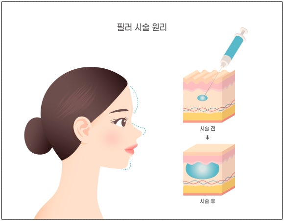 Precautions When Getting Filler for the Corners of the Mouth in Mok-dong <Written by a Doctor> image 3