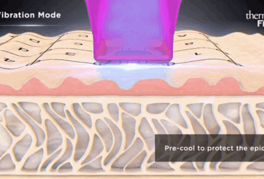 Mokdong Thermage: How Can You Get the Best Results? image 3