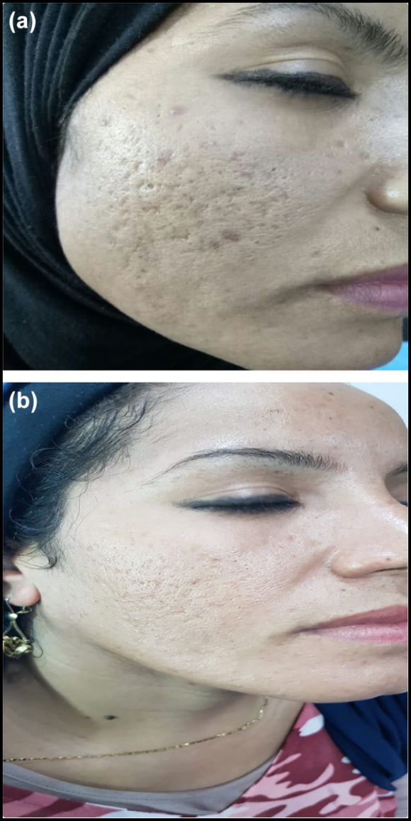Mokdong Fraxel: Reviewing the Effects on Enlarged Pores and Acne Scars Through Research Papers image 7