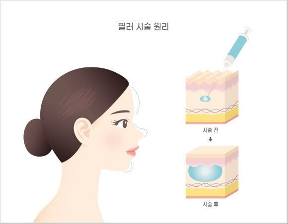 오목교역필러, 내가 받아도 효과 있을까? 관련 이미지 3