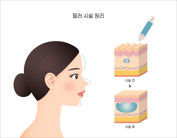 UN&I Mokdong Filler, Before the Procedure image 3