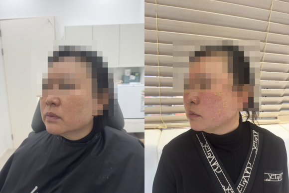 Mok-dong Thread Lifting with a Design Suited to Each Individual image 4