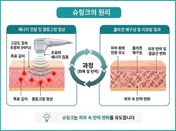 Mok-dong Shurink: What Treatment Criteria Matter More Than Results and Shot Count? image 2
