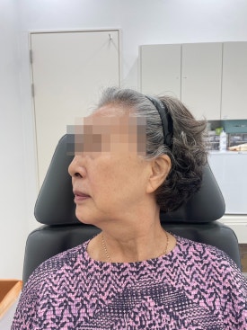 When Fillers Alone Aren’t Enough: Mokdong Thread Lifting image 7