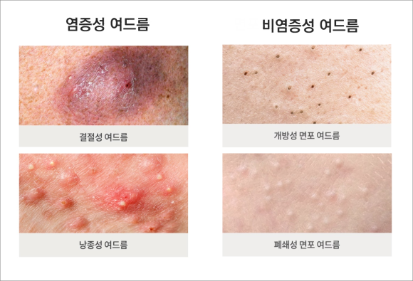 Yangcheon-gu Acne Treatment: Don’t Just Squeeze It image 3