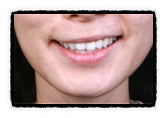 Precautions When Getting Filler for the Corners of the Mouth in Mok-dong <Written by a Doctor> image 8