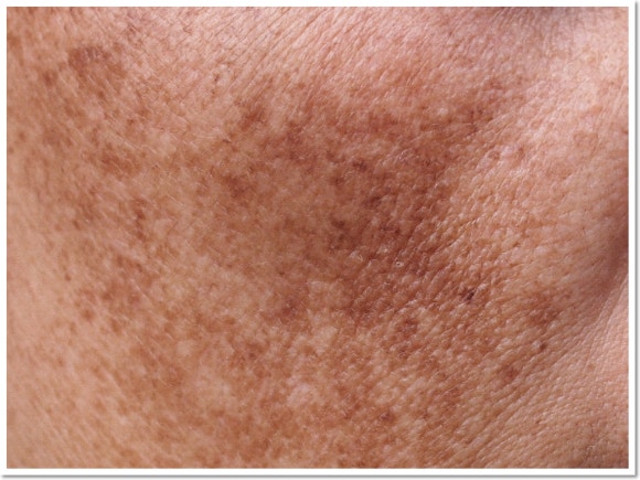 If Mokdong Melasma Removal Treatment Is Not Working Well, Be Sure to Check This image 2