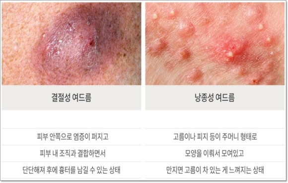 Yangcheon-gu Acne Treatment: What Are the Customized Strategies by Type? image 5